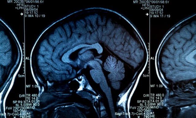 TBI